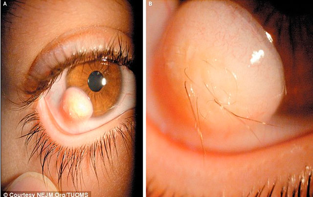 Sí, le salió un verruga con pelo en la pepa del ojo (Foto + iuuu)