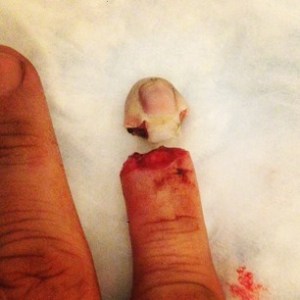 Ex de Sandra Bullock pierde un dedo (Fotos + asquito)
