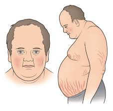 Cushing: Un trastorno hormonal degenerativo confundido con obesidad