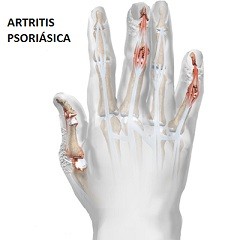 Artritis Psoriásica: inflamación y deformación articular