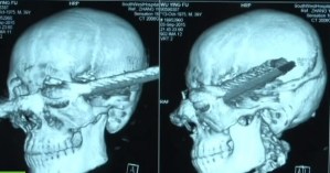 Una barra de acero le atravesó la cabeza y sobrevivió (Video)