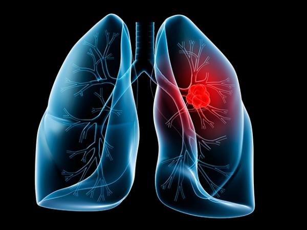 Un tratamiento contra el cáncer de pulmón reduce el riesgo de muerte un 51 %