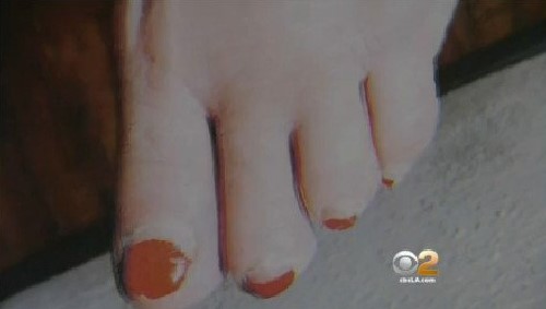 Le amputaron un dedo por hacerse la pedicure (FOTO)