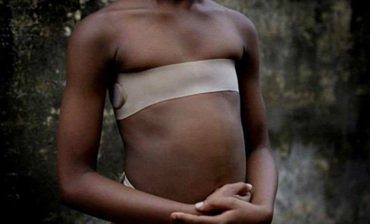 “Senos planchados”: La dolorosa y humillante mutilación femenina (Video)