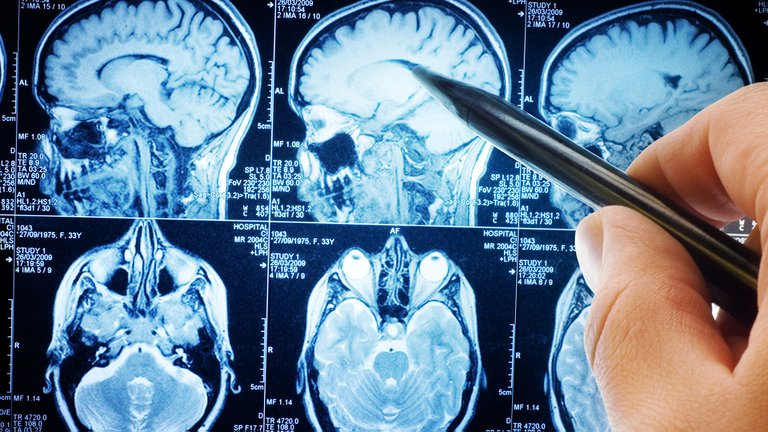 La extraña pregunta de una prestigiosa revista de ciencia: ¿Es realmente necesario el cerebro?