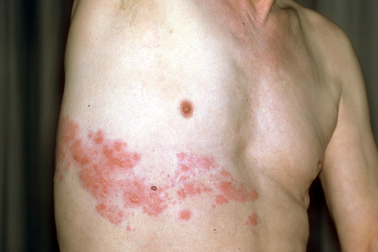 Aparición de herpes puede estar vinculada a la vacuna contra el Covid-19, según estudio
