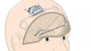 Gran avance médico: implante cerebral podría revertir los síntomas del párkinson