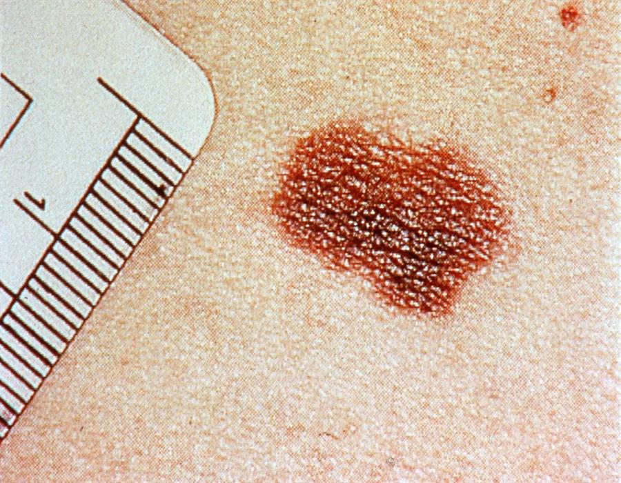 Nuevos marcadores del melanoma explican sus orígenes y desencadenantes